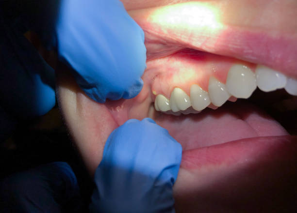 Best Emergency Tooth Extraction in Clintondale, NY